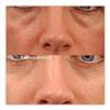Botox Amsterdam